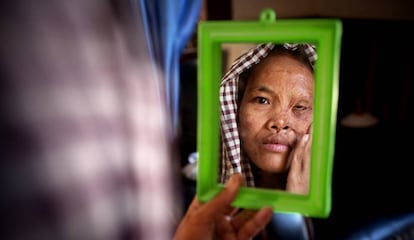 Una mujer mira en el espejo su rostro quemado por ácido.