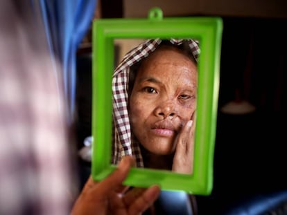 Una mujer mira en el espejo su rostro quemado por ácido.