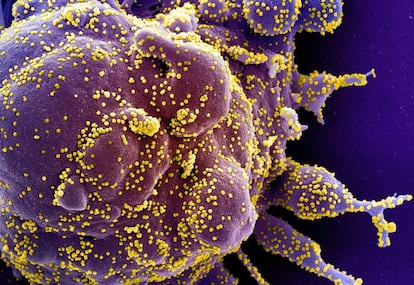 Electron micrograph of a human cell infected with particles of the SARS-CoV-2 virus.