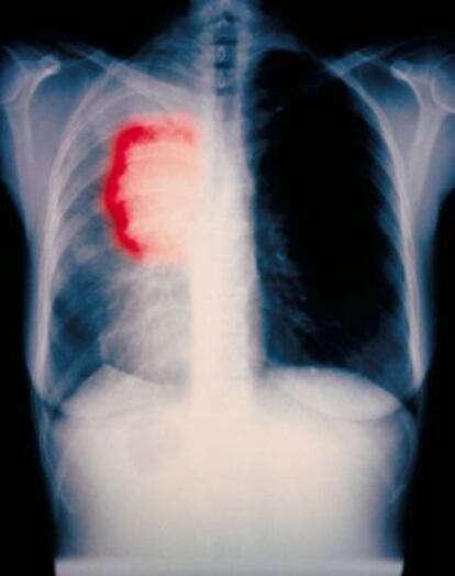 Radiografía de un cáncer de pulmón.