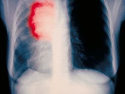 Radiografía de un cáncer de pulmón.