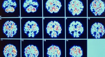 Imágenes del cerebro de un paciente con alzhéimer obtenidas mediante tomografía por emisión de positrones (PET).