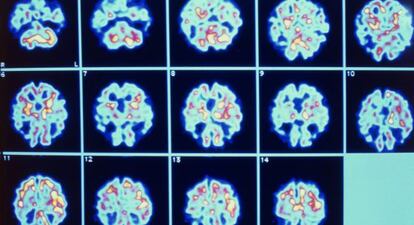 Im&aacute;genes del cerebro de un paciente con alzh&eacute;imer obtenidas mediante tomograf&iacute;a por emisi&oacute;n de positrones (PET). 