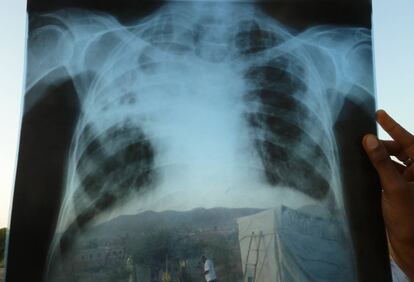 Un médico de MSF en Etiopía fotografía una radiografía para enviarla por el servicio de telemedicina.