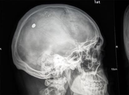 Radiografía del cráneo de M. P. D. El perdigón es el punto blanco que se ve en la parte superior izquierda.