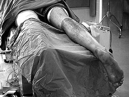 Un paciente, listo para ser operado en el tendón de Aquiles con la nueva cirugía semipercutánea de mínima incisión.