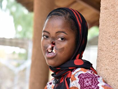 Una chica con noma posa en un centro de la ONG Sentinelles en Zinder (Níger).