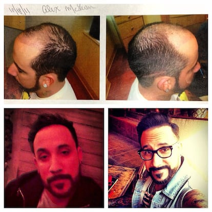 En abril de 2013, AJ McLean, cantante de los Backstreet Boys, publicó en su cuenta de Instagram varias fotos del antes y después de su implante de pelo. "Algunas mujeres se operan los pechos y algunos hombres se implantan abdominales para ser felices. ¡Esto es lo que yo hice y no podría ser más feliz!", decía junto al collage de fotos.