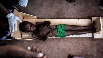 Un niño con malnutrición es medido en una clínica especializada en combatir esta enfermedad en Tshikapa, República Democrática del Congo, en octubre de 2017.
