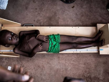 Un niño con malnutrición es medido en una clínica especializada en combatir esta enfermedad en Tshikapa, República Democrática del Congo, en octubre de 2017.