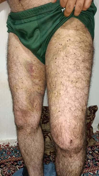 Las piernas del kurdo iraní Peyman Golabi, tras recibir un disparo de escopeta con 200 perdigones.