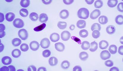 Muestra de sangre que contiene varias formas del parásito de la malaria, 'Plasmodium falciparum'