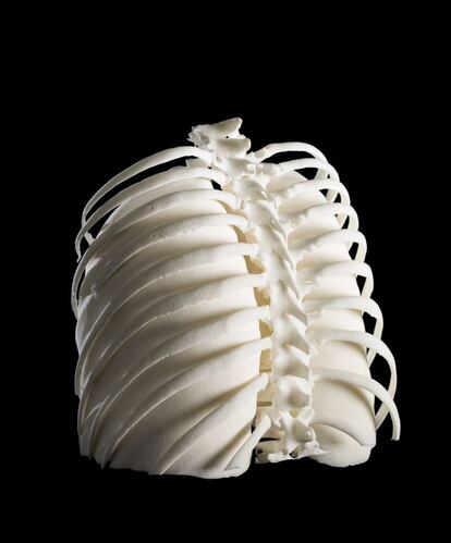 Imagen de unos pulmones humanos, vistos desde atrás, con la estructura de la columna vertebral y las costillas protegiéndolos. Representa los pulmones de una mujer diagnosticada con linfoma de Hodgkin. Los datos en 2D que los médicos obtuvieron de sus pruebas sirvieron para elaborar esta ilustración en 3D.