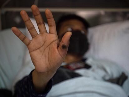Un paciente muestra una llaga provocada por la mpox durante su confinamiento en el área de aislamiento del hospital Arzobispo Loayza, en Lima (Perú), el pasado agosto. En total, más de 90.000 personas se han contagiado.