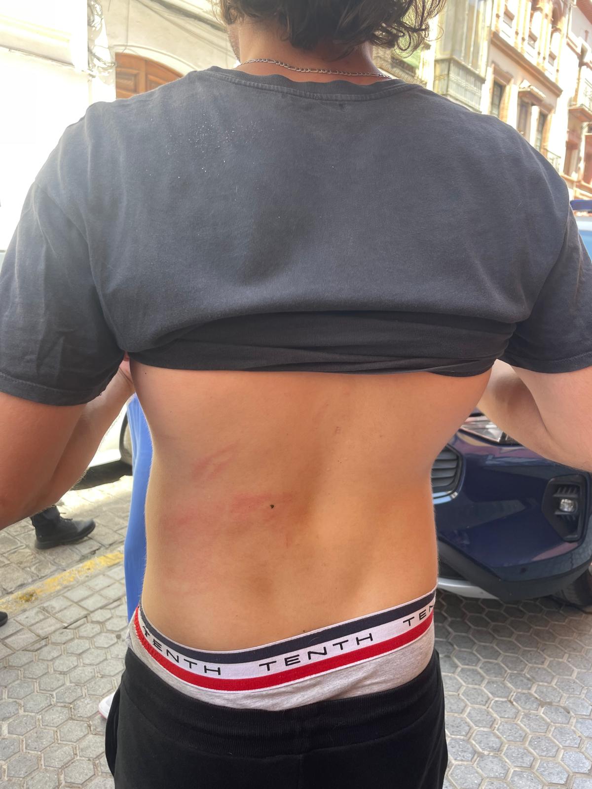 Marcas de las lesiones de uno de los jóvenes agredidos por los empleados de una empresa 'desokupa', en Sevilla. / ESE