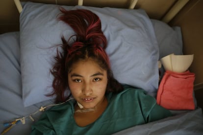 <p>La Paz, Bolivia, 3 de junio de 2019: Paola Cruz, de 15 años, descansa en una cama del Hospital de Clínicas después de que le amputaran la pierna derecha a causa de un cáncer. La enfermedad le fue diagnosticada cuando cursaba cuarto de Secundaria en la escuela Gregorio Pacheco, en las afueras del pueblo de Uyuni. La adolescente, madre de un niño de un año, creció en esta localidad pegada al salar que ha dado fama a este rincón del país: pese a ser uno de los grandes atractivos turísticos de Bolivia y la mayor reserva de litio del mundo, la mayoría de la población de la zona vive sumida en la pobreza. </p> <p>Míriam, la madre de Paola, cuenta que el problema de su hija empezó por una caída en el colegio: se golpeó la rodilla y se hizo un pequeño corte. Llevaron a la niña a un médico de Uyuni, que le dijo que no tenía nada grave y le hizo una curación sencilla. Pasaron varios meses. Un día, Paola se encontraba en casa cuando de pronto la pierna le falló y se fue directa al suelo. La llevaron a un hospital en el pueblo, donde detectaron un tumor en el lugar donde se había golpeado tiempo atrás y le dijeron que era necesario hacer una biopsia.</p>