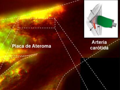 Imagen de alta resolución de la placa de ateroma en la arteria carótida