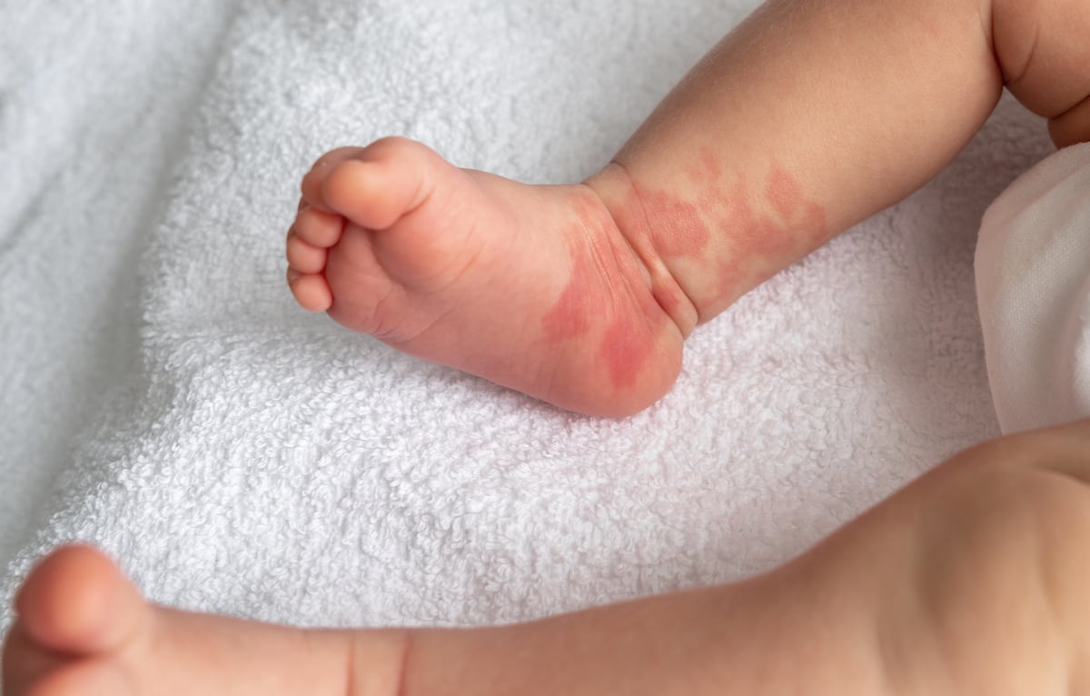 孕妇的食欲和宝宝的红斑有什么关系？| 石斧 | 科学