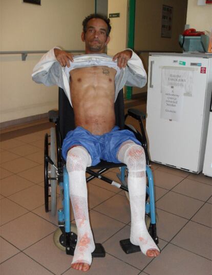 Janos, de 38 años, afectado por la riada de barro rojo muestra sus heridas en el Hospital Provincial de Veszprem.