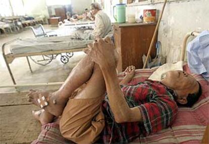Una enfermo de lepra, en un hospital de Indionesia, el segundo país asiático con más casos después de India.