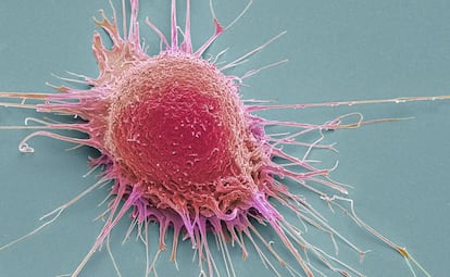 Célula de cáncer de próstata en una imagen de escáner coloreada