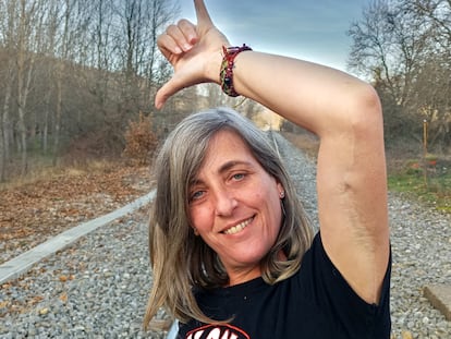 Biologist Patricia Casas Rodríguez shows scars from the flesh-eating bacteria.