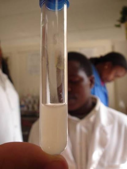 Imagen de líquido cefalorraquideo turbio, diagnóstico de meningitis.
