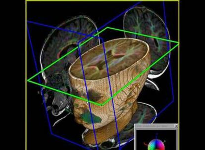 Resonancia magnética del cerebro de un niño de 12 meses.