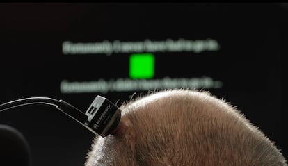 Detalle del aparato cerebro-computador, BCI, conectado a la cabeza de Casey Harrel, en una imagen cedida por la Universidad de California.