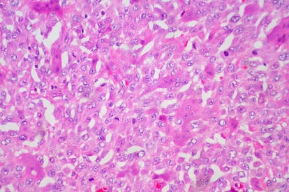 Neoplasia de células gigantes del tejido subcutáneo.