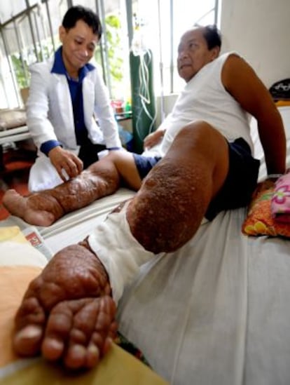 Un m&eacute;dico trata a un paciente infectado con filariasis en Filipinas.