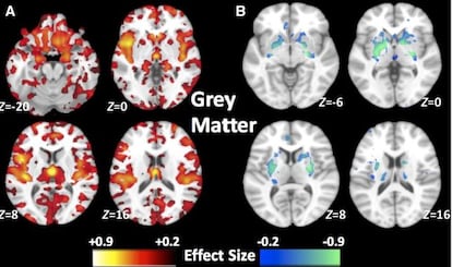 Patrones de volúmenes de materia gris en  dos subtipos de esquizofrenia.