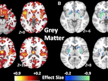 Patrones de volúmenes de materia gris en  dos subtipos de esquizofrenia.