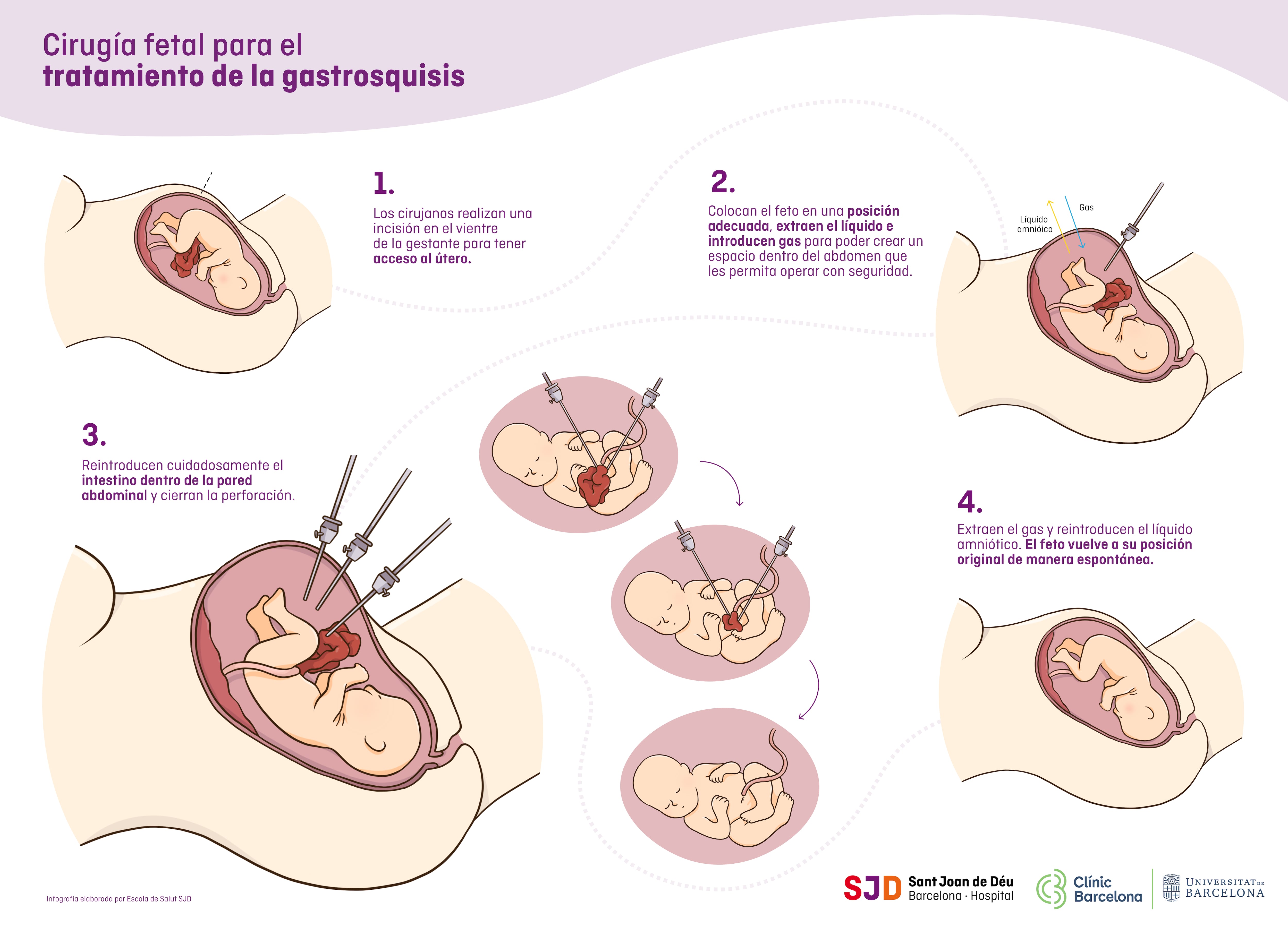 Infografía de la cirugía fetal para el tratamiento de la gastrosquisis