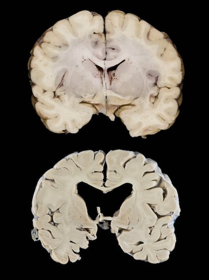 Cerebro con alzhéimer. 