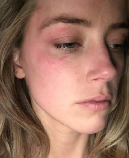 Imagen de Amber Heard tras una supuesta agresión de Johnny Depp.