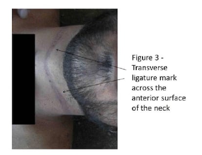 La marca de una soga o cinturón que atraviesa el cuello de un cadáver.