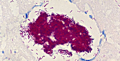 Imagen al microscopio de la bacteria que produce la úlcera de Buruli.