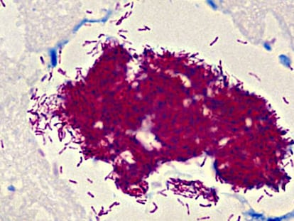 Imagen al microscopio de la bacteria que produce la úlcera de Buruli.