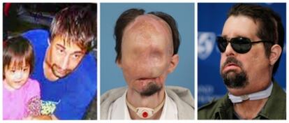 Fotografías de Dallas Wiens antes del accidente que le desfiguró el rostro en 2008, después, y con su nueva cara tras ser trasplantado.