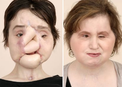 Katie Stubblefield antes y después de la operación
