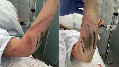 La mujer atropellada muestra las heridas en el brazo después de ser atropellada.