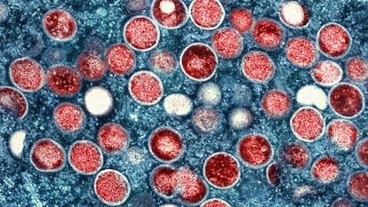 Colored monkeypox particles seen through an electron microscope.