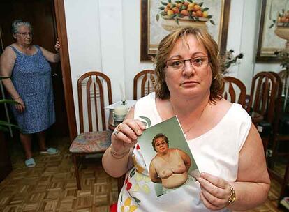 Juana Ledesma muestra una fotografía con el estado de sus pechos tras las intervenciones.