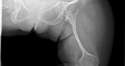 Radiografía de una persona afectada de osteogénesis imperfecta en la que se observan varias fracturas.