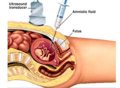 En 2005 se realizaron 50.000 amniocentesis en España.