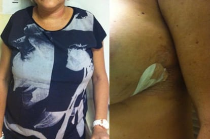 A Venezuelan woman coming from Colombia was discovered to have recently undergone breast surgery. She became nervous when told she would be taken to hospital for checks to see if she was carrying drugs and admitted to police that cocaine had been put in her implants. She underwent surgery and around 1.7 kilograms of liquid cocaine was found in two plastic bags in her implants.