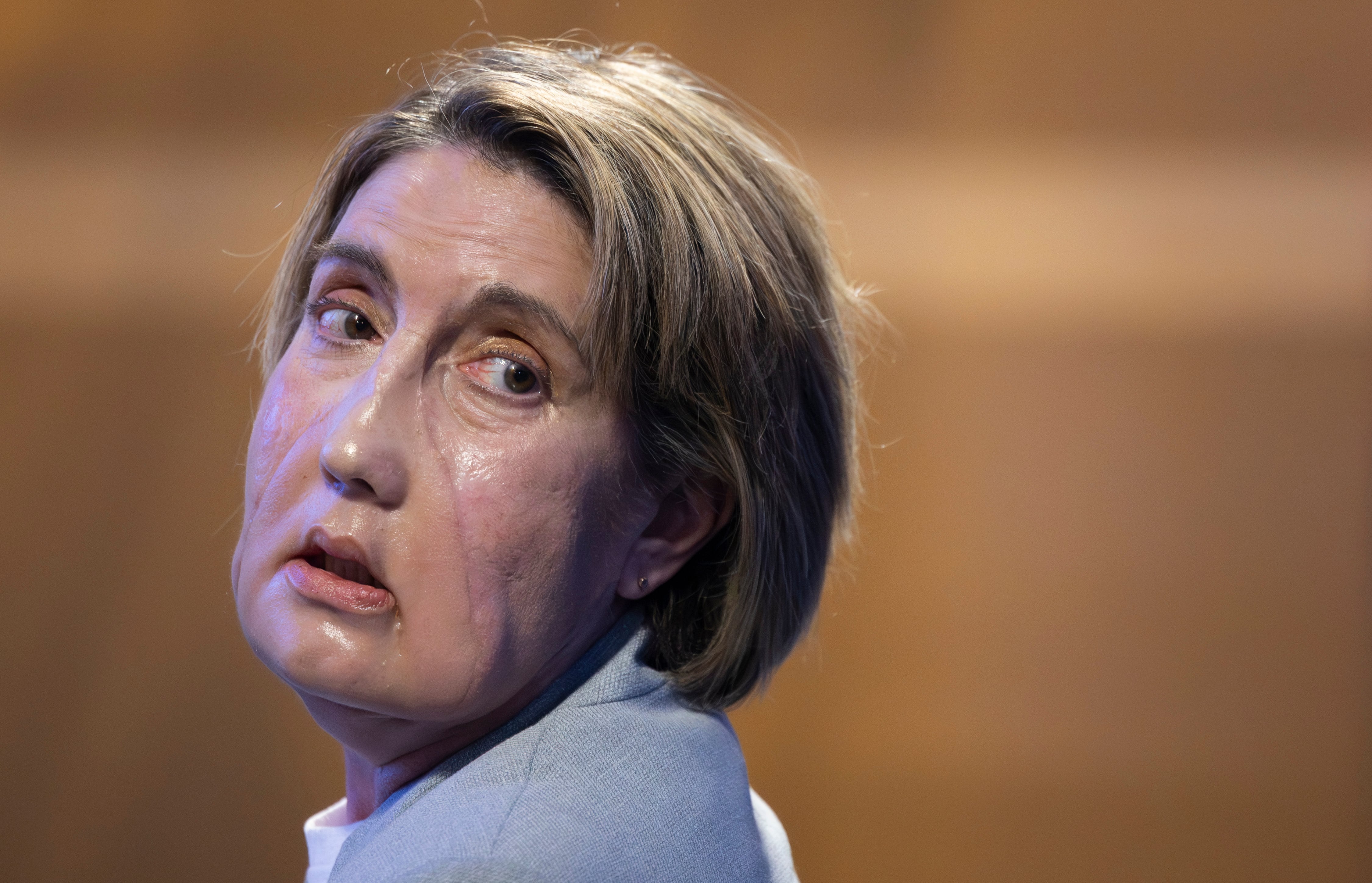 Carme, primera paciente en el mundo que ha recibido un trasplante de cara con tejido procedente de una donante que recibió la eutanasia.