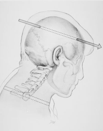 Ilustración que recrea la herida fatal de JFK.