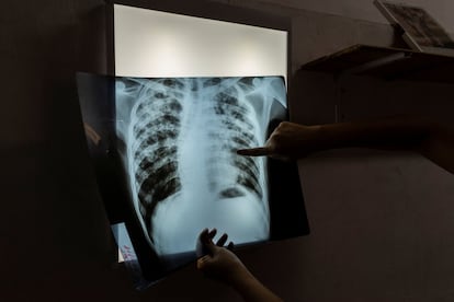 Mariela, especialista en enfermedades infecciosas, examina la radiografía de Jorge, un paciente de 24 años en tratamiento contra la tuberculosis, en Buenos Aires, Argentina.